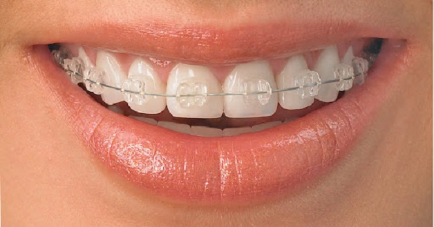 Mắc cài sứ hoặc pha lê